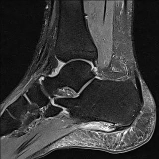 足踝矢狀面磁振造影（MRI）影像