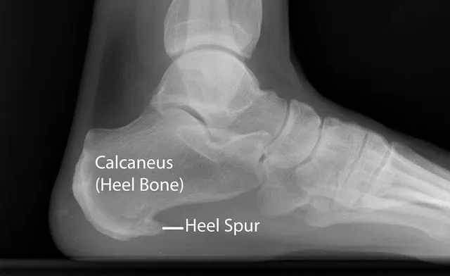 足部側面 X 光影像，標示跟骨（Calcaneus）與跟骨骨刺（Heel Spur）