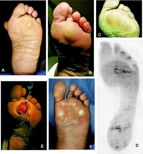 臨床照片集(A–F):前足胼胝等足底病灶、足壓圖與手術所見