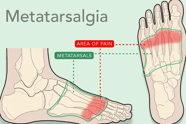 蹠骨痛(Metatarsalgia)示意圖:足側面與俯視圖,標示蹠骨與前足疼痛區